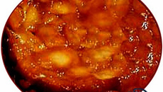 Tarte tatin pommes et mangues