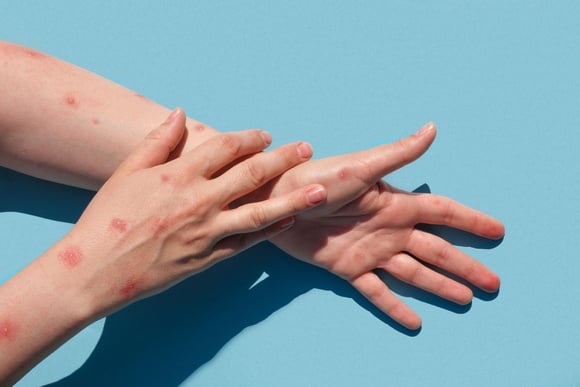 Les symptômes de la variole du singe. Adobestock