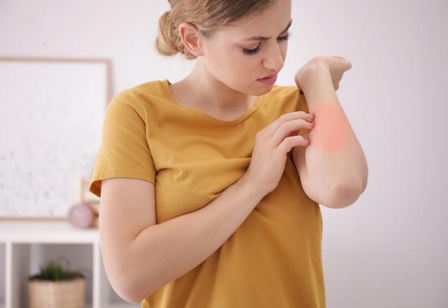 Eczéma : quels sont les aliments à privilégier pour lutter contre ce problème de peau ?