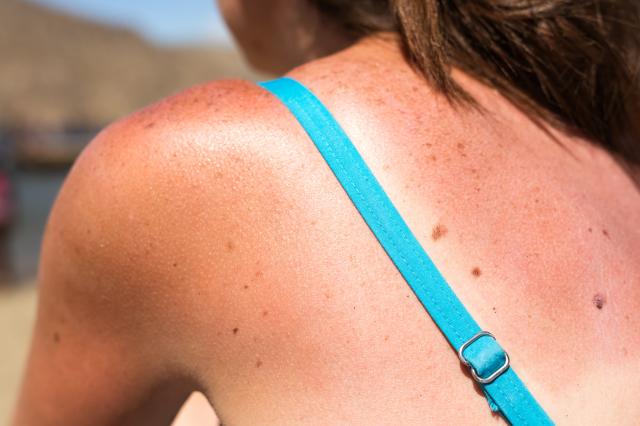 Ne jetez pas la peau de ce fruit de saison, elle pourrait être utilisée contre les brûlures du soleil cet été !